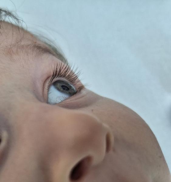 Je žilka v oku dieťaťa dôvod na obavy?