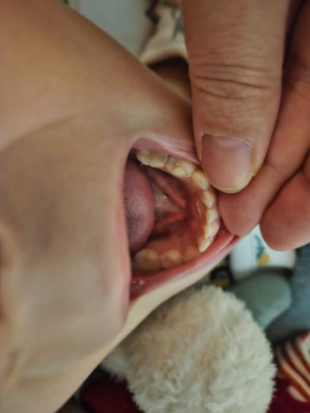 Prvý nový zub rastie a mliečny sa len slabo kolíše