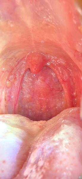Žlté pľuzgieriky v hrdle: čo môže byť príčinou?