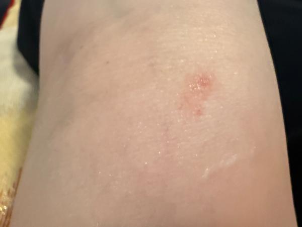 Môže to byť svrab?