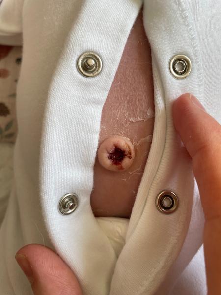 Pupok novorodenca: Ako čistiť po odpadnutí pahýľa?