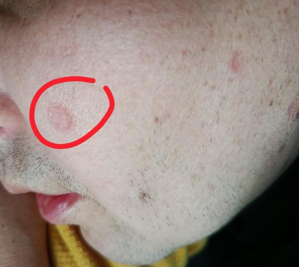 Kožné problémy: Ktorý krém bez predpisu je najlepší?