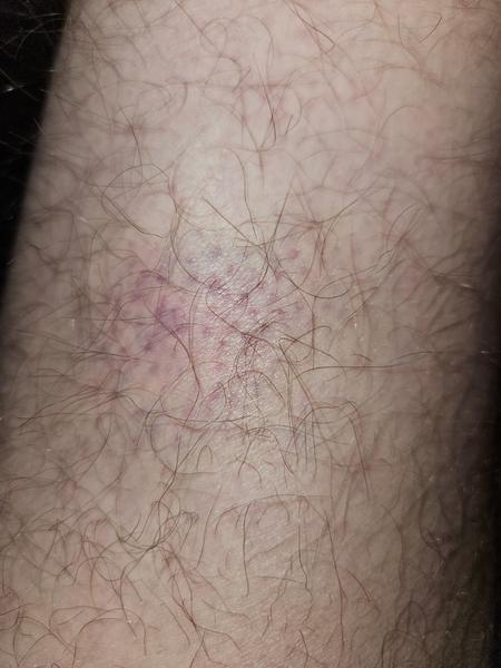 Modrina na nohe bez zjavnej príčiny