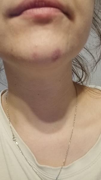 Prečo sa mi cyklicky objavuje a mizne fľak na brade?