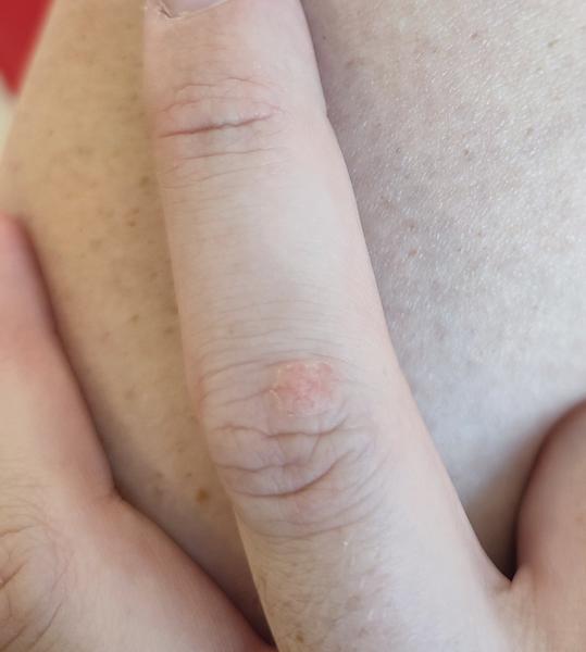 Je to bradavica alebo niečo iné?