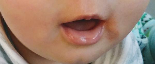 Čo pomôže 8 mesačnému dieťaťu na suché červené miesta od slín?