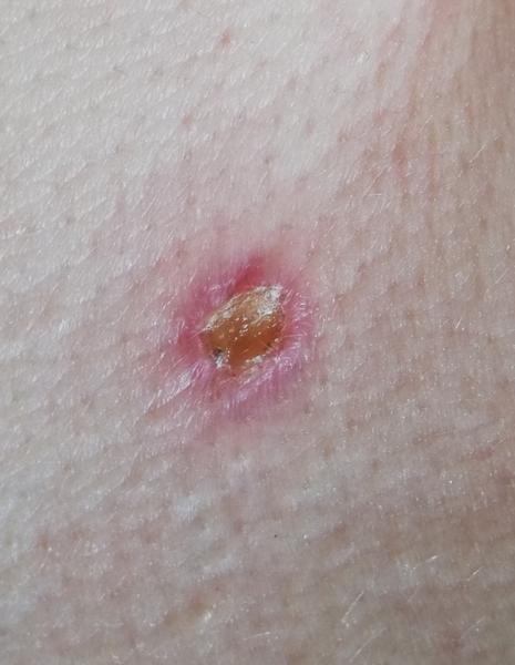 Prečo stred vypáleného fibrínu mokvá?