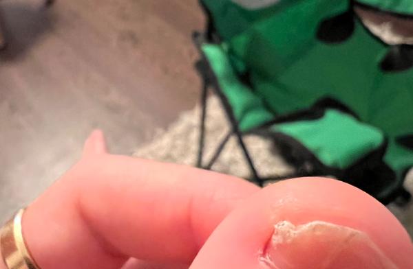 Nepekný nechtík na synovej nožičke