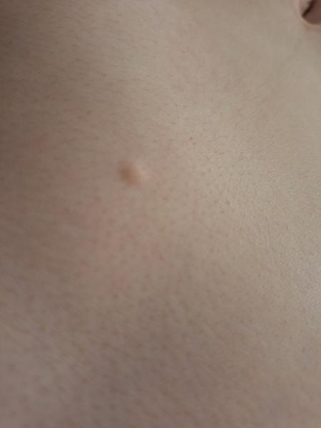 Čo robiť pri tvrdých hrčiach na tele?