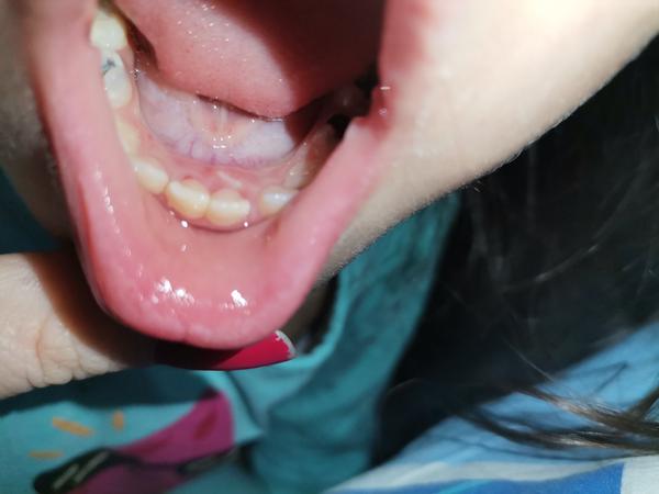 5,5 ročná dcéra má zatiaľ všetky zúbky