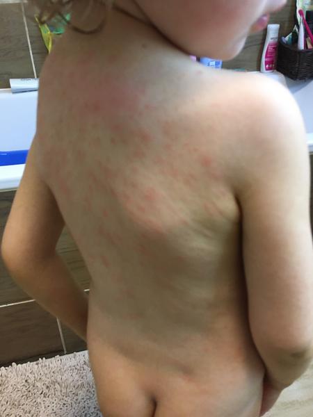 Dlhodobé vyrážky po chorobe u dieťaťa