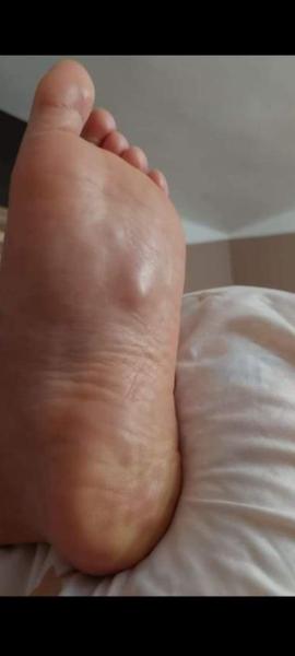 Čo sa mi vytvorilo na chodidle?