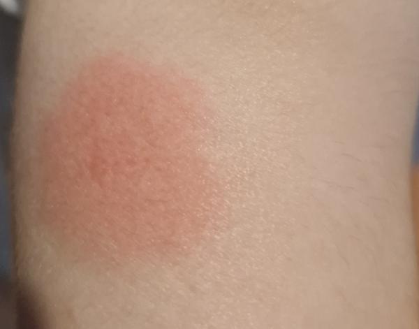 Čo môže byť tento štípanec na nohe dcérky?