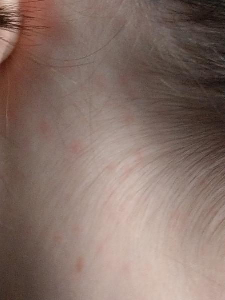 Svrbí vás hlava a máte vyrážky? Poradíme vám!