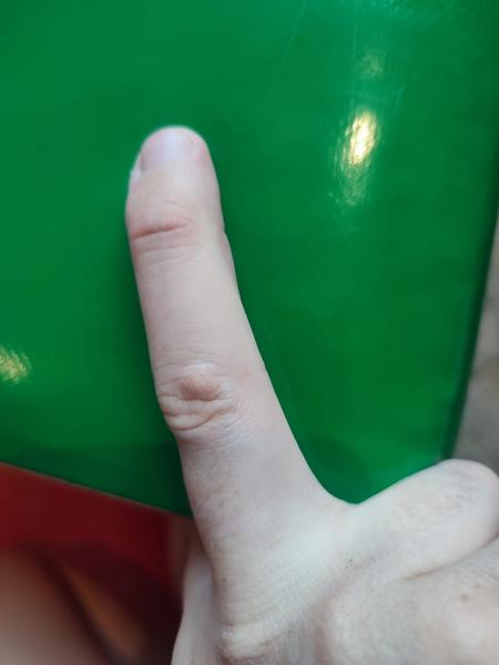 Je to bradavica alebo niečo iné?