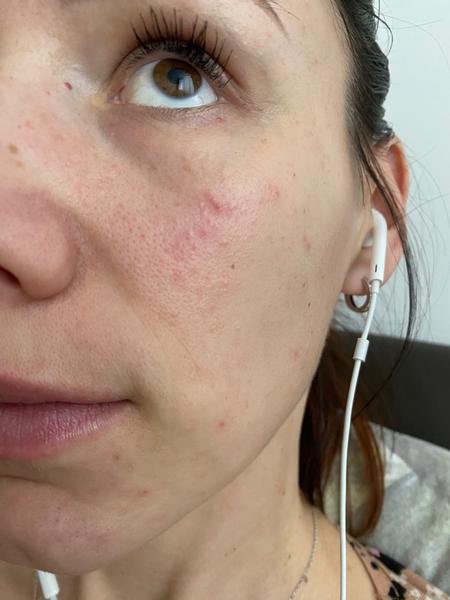 Kožný problém na tvári