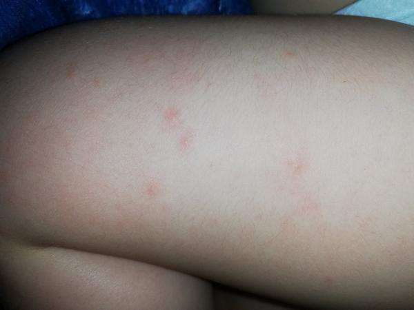 Vyrážky na nohách