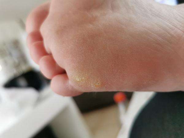 Mám bradavice alebo kurie oká?