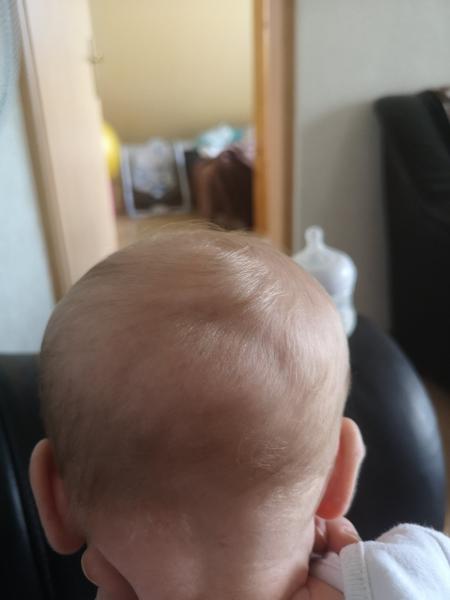 Mesačná dcérka má vzadu na hlavičke priehlbinku