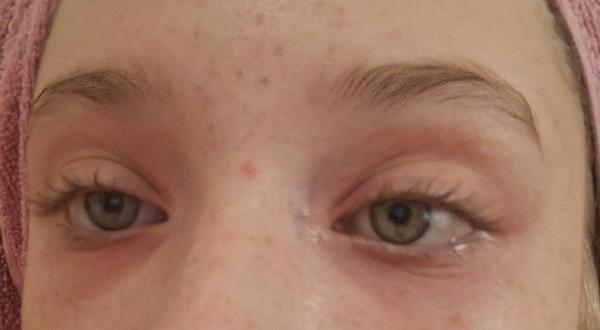 Čo spôsobuje začervenanie okolo očí?