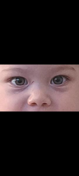 Pomoc s poruchou zraku u 18-mesačného dieťaťa