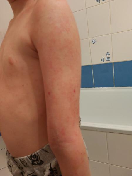 Aké vyrážky má moje dieťa?