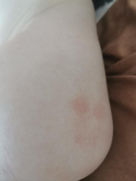 Aké vyrážky má moja dcérka?