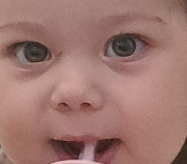 Pomoc s poruchou zraku u 18-mesačného dieťaťa