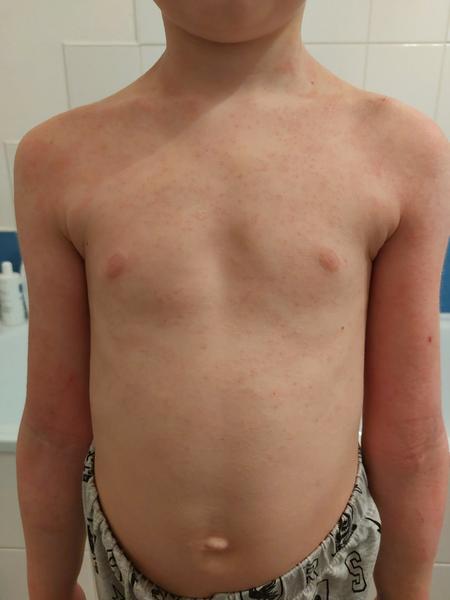 Aké vyrážky má moje dieťa?