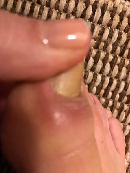 Zapálene opuchnuté nechtové lôžko