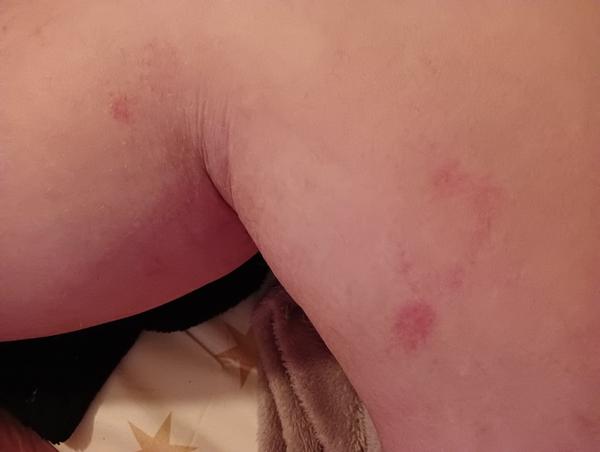 Z čoho sú neškodné fľaky na pokožke?