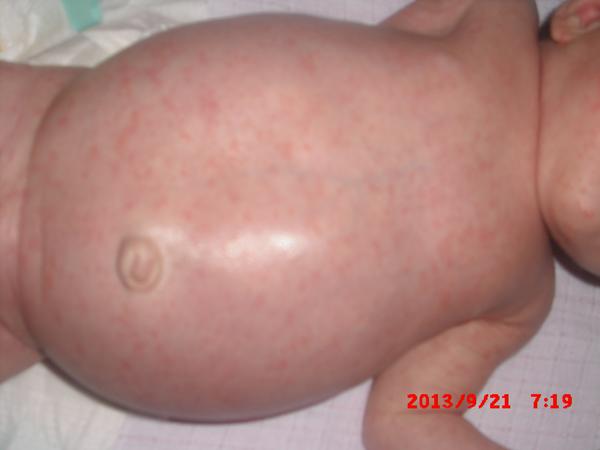 Čo sú tieto červené vyrážky?