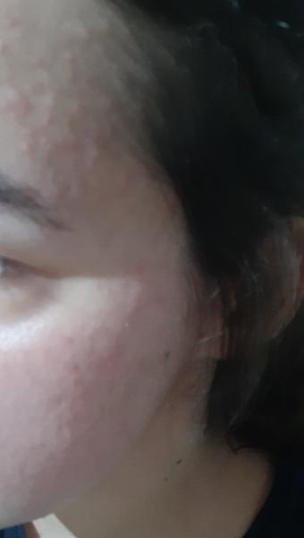 Vyrážky na tvári, krku a šiji