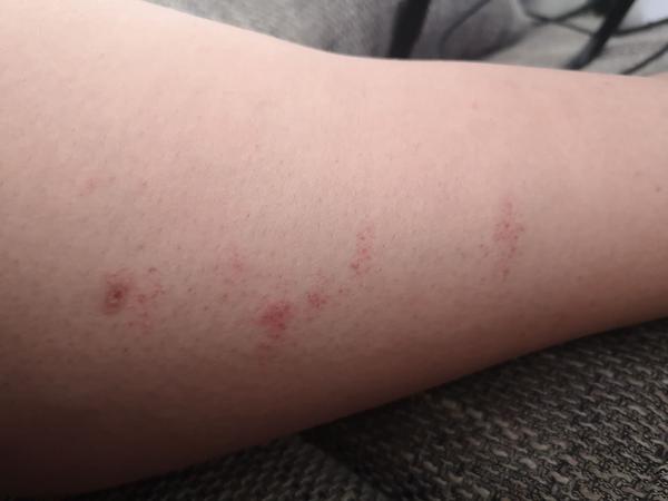 Prečo sa mi robia fľaky na nohách?