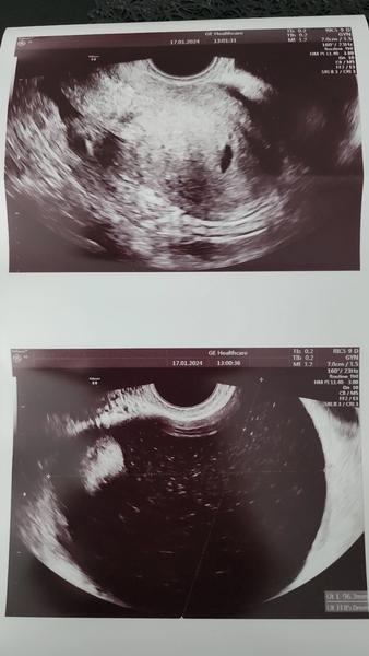 Máte skúsenosť s gestačným vakom, cystou a nízkym hCG?