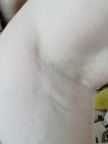 Čo robiť pri zdurenine pod pazuchou?