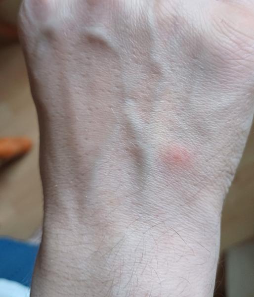 Rozpoznáte blšie štípance na pokožke?