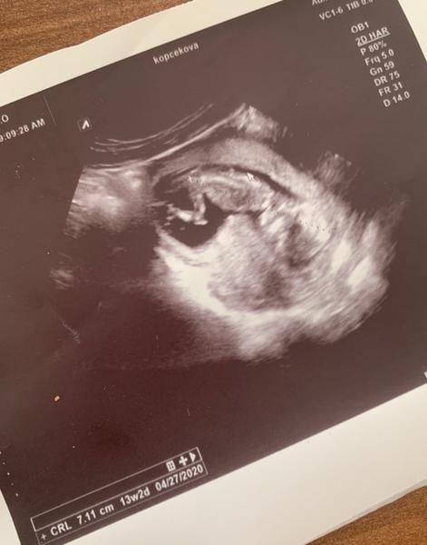 Je takáto velkosť maternice pre dieťa v 13. týždni v poriadku?