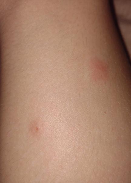 Od čoho sú tieto štípance?