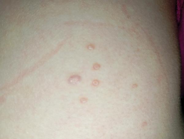 Čo môže spôsobovať pľuzgieriky na chrbáte a rukách?