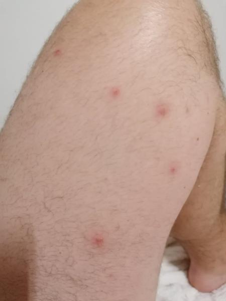 Ide o uhryznutie plošticou?