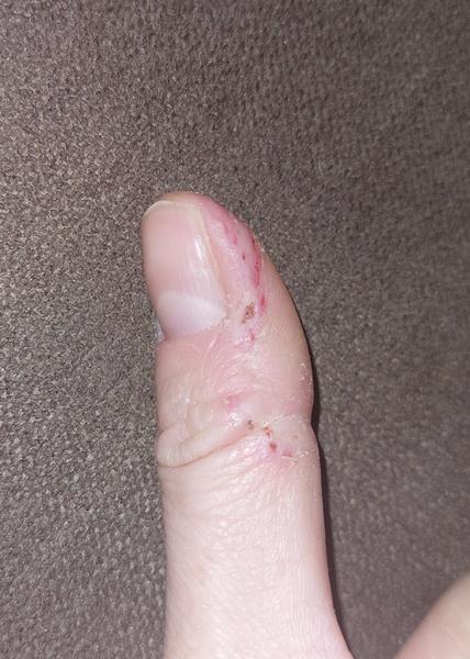 Ako riešiť znetvorenú kožu okolo nechtov?