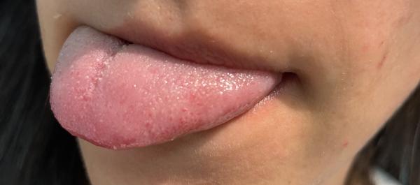 Červené bodky na špičke jazyka