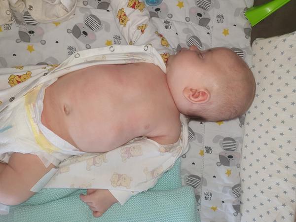 Atopický ekzém u trojmesačného