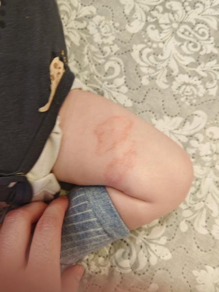 Čo spôsobuje dlhodobé červené fľaky na tele?