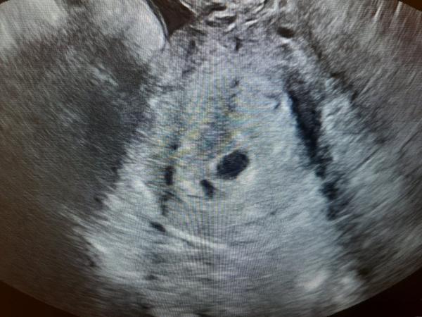 Prázdny vačok v 6. týždni