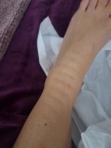 Zvláštne pruhy na nohe bez bolesti a svrbenia