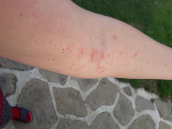 Čo môžu znamenať tieto štípance / vyhádzanie?