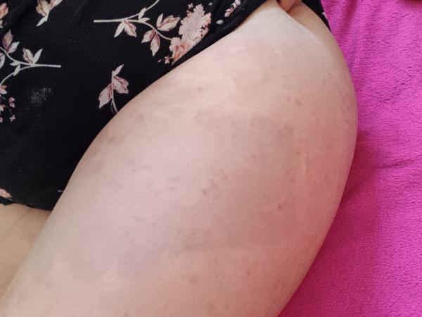 Má môj syn pityriasis rosea? Skúsenosti ostatných vítané