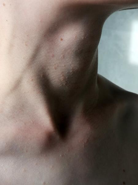 Ako sa zbaviť vyrážok na krku u detí?